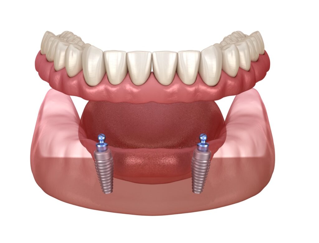 Removable dentures on implants